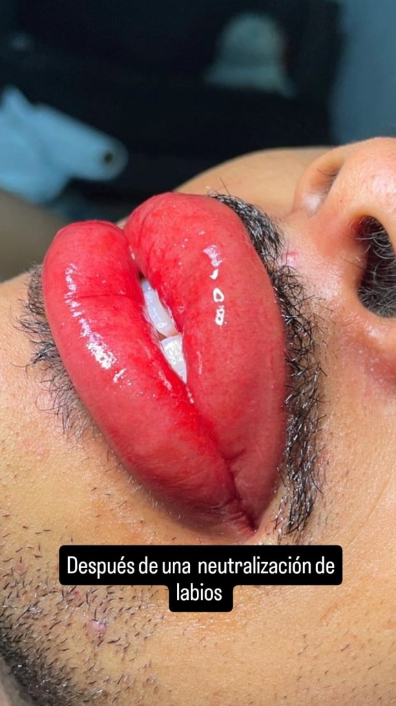 Después de neutralización de labios