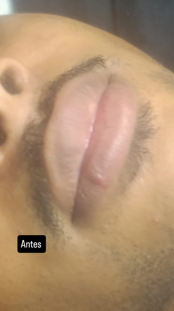 Labios antes del tratamiento